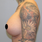 Breast Augmentation Before & After Patient #1629