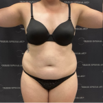 Liposuction Before & After Patient #1691