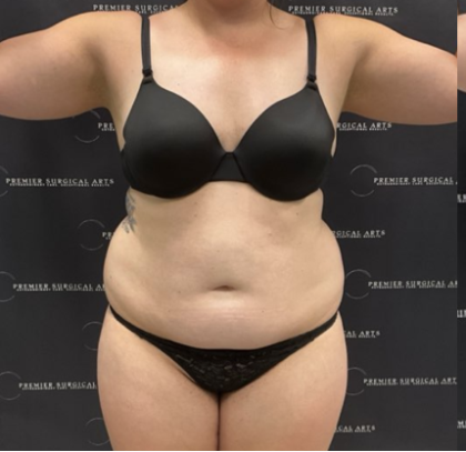 Liposuction Before & After Patient #1691