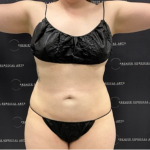 Liposuction Before & After Patient #1691