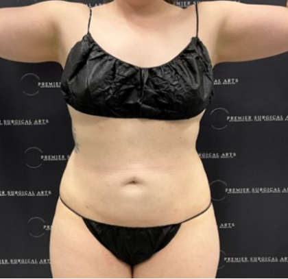 Liposuction Before & After Patient #1691
