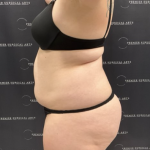 Liposuction Before & After Patient #1691