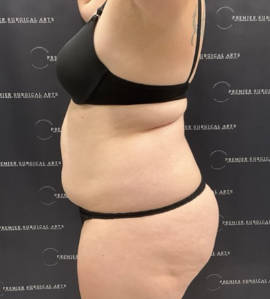 Liposuction Before & After Patient #1691