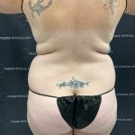 Liposuction Before & After Patient #1691