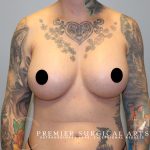 Breast Augmentation Before & After Patient #1629