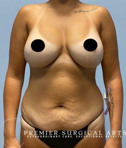 Body Contouring Before & After Patient #1624