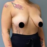Breast Augmentation Before & After Patient #1483