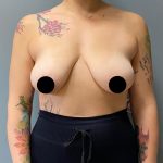 Breast Augmentation Before & After Patient #1483