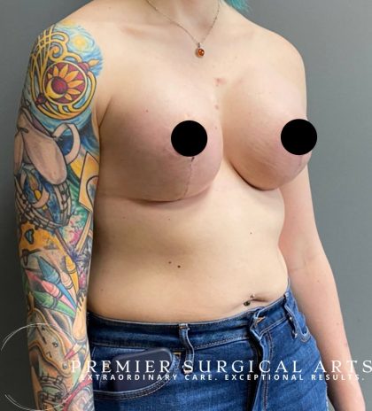 Breast Augmentation Before & After Patient #1476