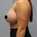 Breast Augmentation Before & After Patient #1496