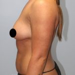 Breast Augmentation Before & After Patient #1496