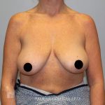 Breast Augmentation Before & After Patient #1491