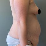 Breast Augmentation Before & After Patient #1529
