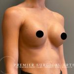 Breast Augmentation Before & After Patient #1506