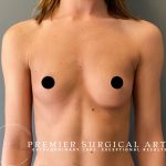 Breast Augmentation Before & After Patient #1506
