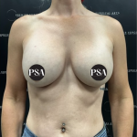 Breast Augmentation Before & After Patient #1486