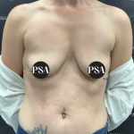 Breast Augmentation Before & After Patient #1486