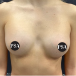 Breast Augmentation Before & After Patient #1519