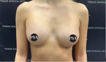 Breast Augmentation Before & After Patient #1519