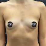 Breast Augmentation Before & After Patient #1519