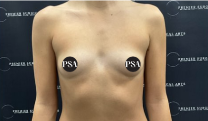 Breast Augmentation Before & After Patient #1519