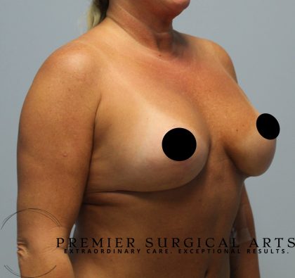 Breast Augmentation + Lift Before & After Patient #1456