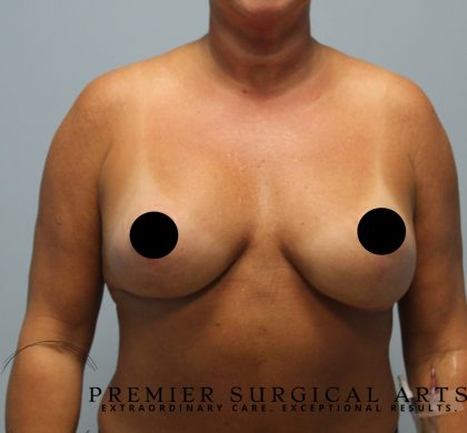 Breast Augmentation + Lift Before & After Patient #1456