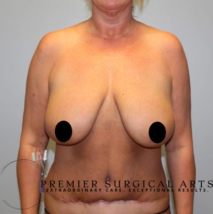 Breast Augmentation + Lift Before & After Patient #1456