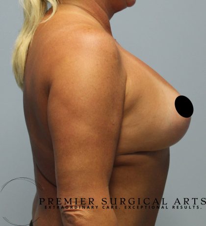 Breast Augmentation + Lift Before & After Patient #1456