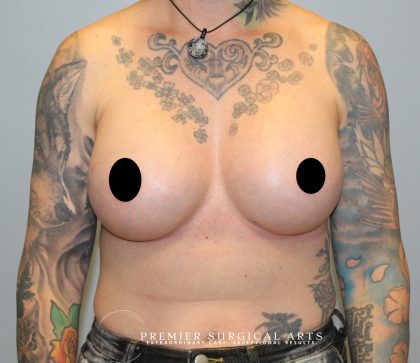 Breast Augmentation + Lift Before & After Patient #1449