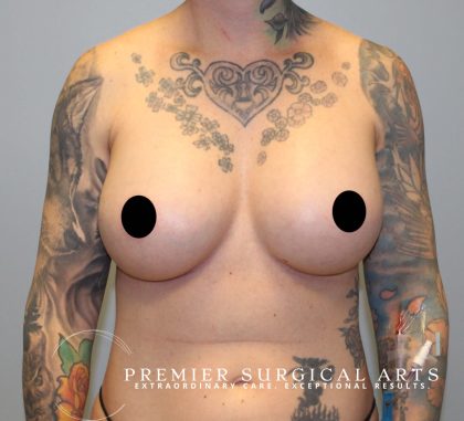 Breast Augmentation + Lift Before & After Patient #1449