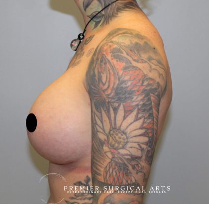 Breast Augmentation + Lift Before & After Patient #1449