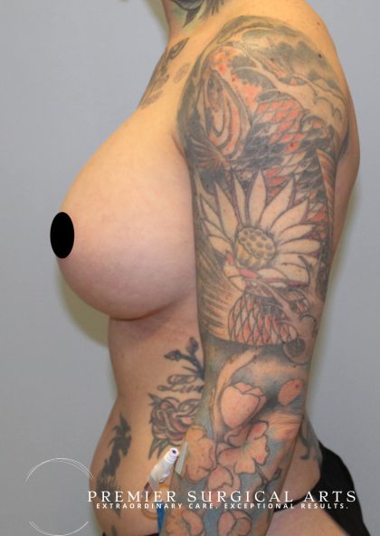 Breast Augmentation + Lift Before & After Patient #1449