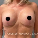 Breast Augmentation + Lift Before & After Patient #1437