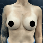 Breast Augmentation + Lift Before & After Patient #1459