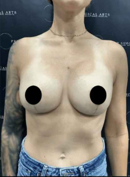 Breast Augmentation + Lift Before & After Patient #1459