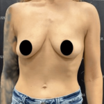 Breast Augmentation + Lift Before & After Patient #1459