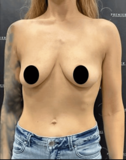 Breast Augmentation + Lift Before & After Patient #1459