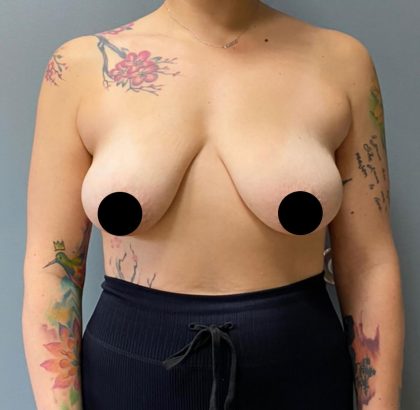 Breast Lift Before & After Patient #1408