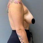 Breast Lift Before & After Patient #1408