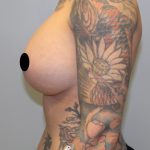 Breast Lift Before & After Patient #1413