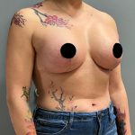 Liposuction Before & After Patient #1548