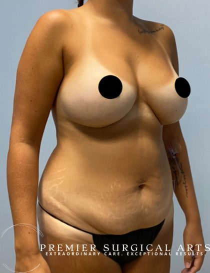 Liposuction Before & After Patient #1560