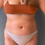 Liposuction Before & After Patient #1574
