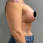 Mommy Makeover Before & After Patient #1588