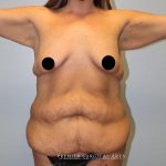 Mommy Makeover Before & After Patient #1593