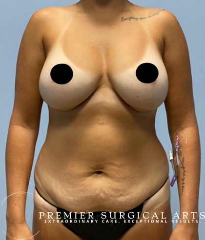 Tummy Tuck Before & After Patient #1651