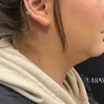 Chin Liposuction Before & After Patient #2100