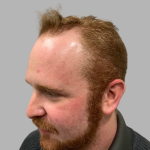 Hair Restoration Before & After Patient #2098