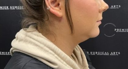 Chin Liposuction Before & After Patient #2100
